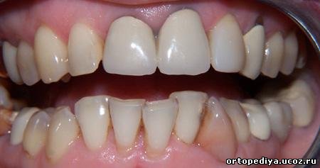 вигляд зубів до лікування